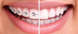 Invisalign® Teeth Straightening